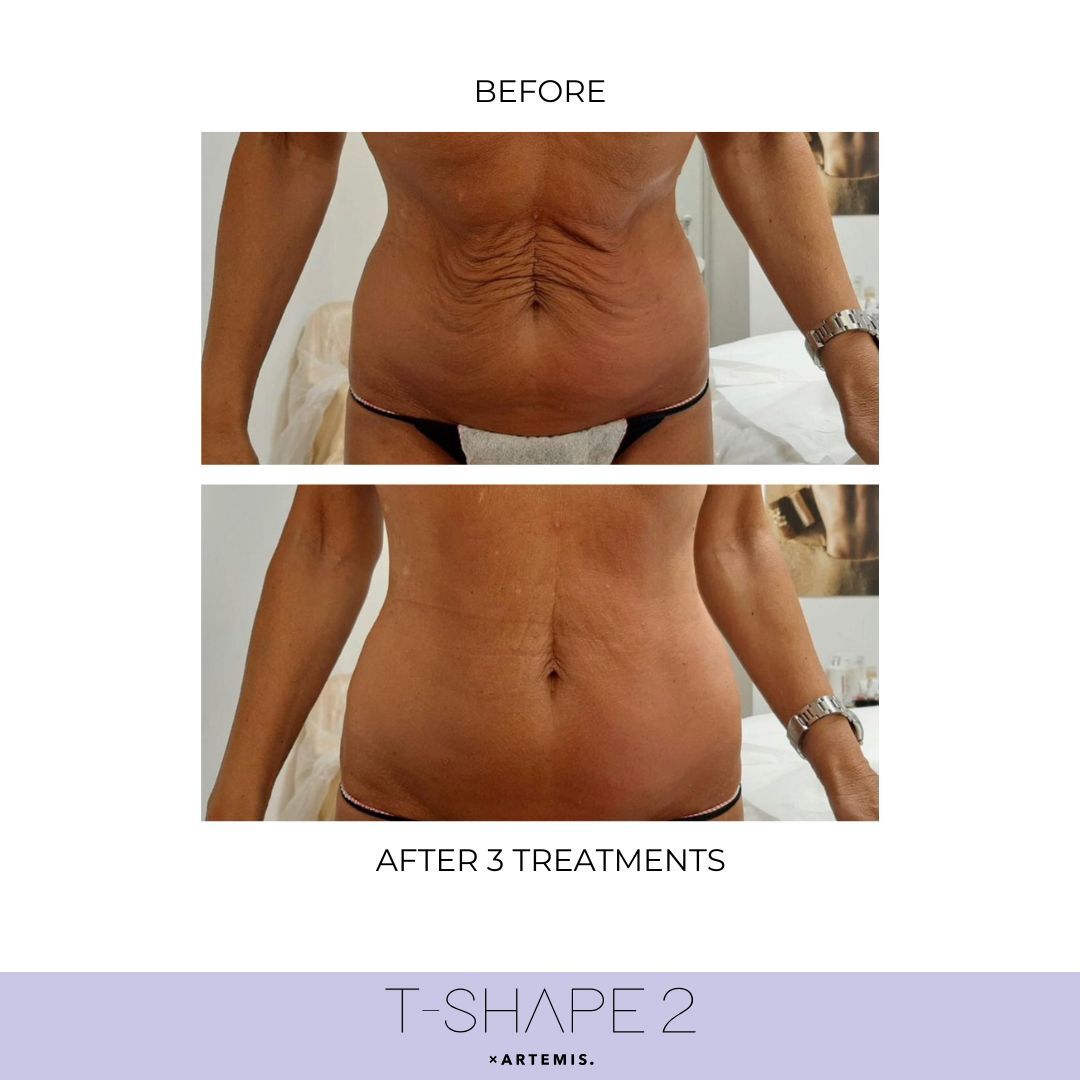 Abdomen T-Shape 2 results — iCRYO Grosse Pointe