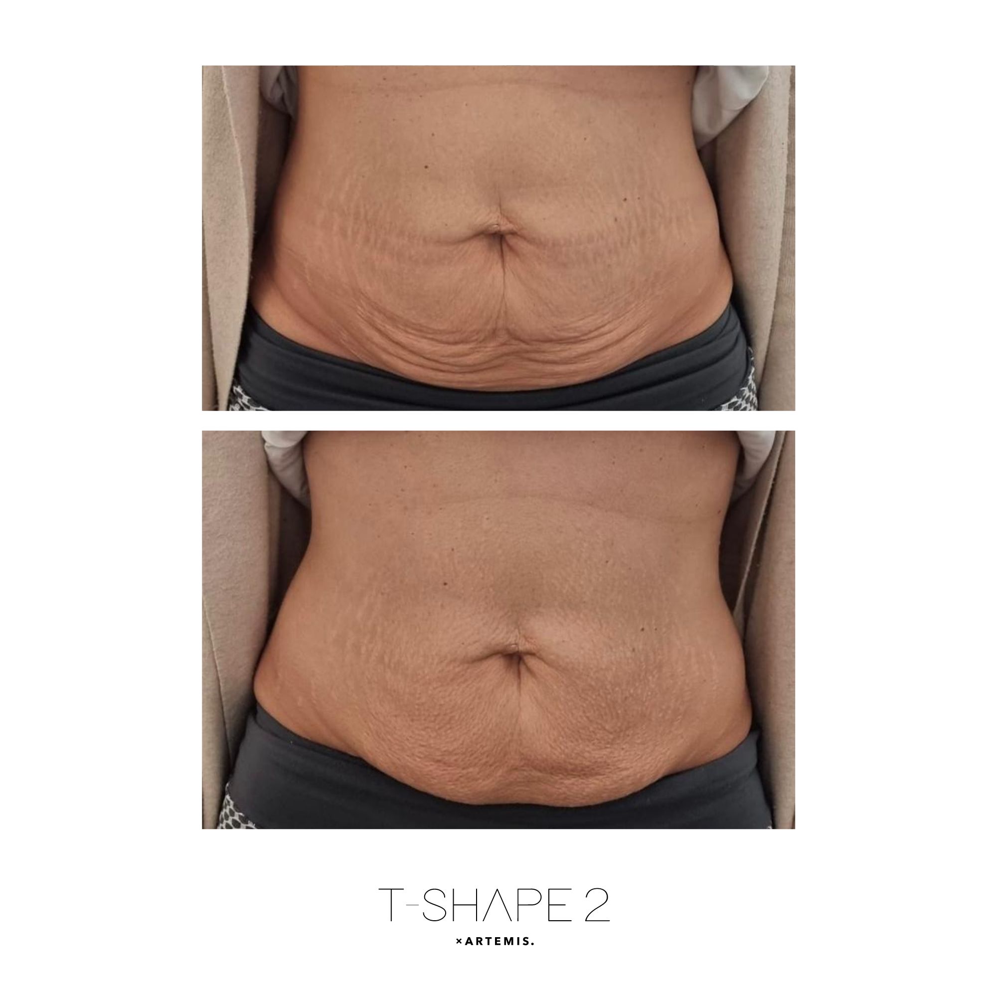 Abs T-Shape 2 results — iCRYO Grosse Pointe