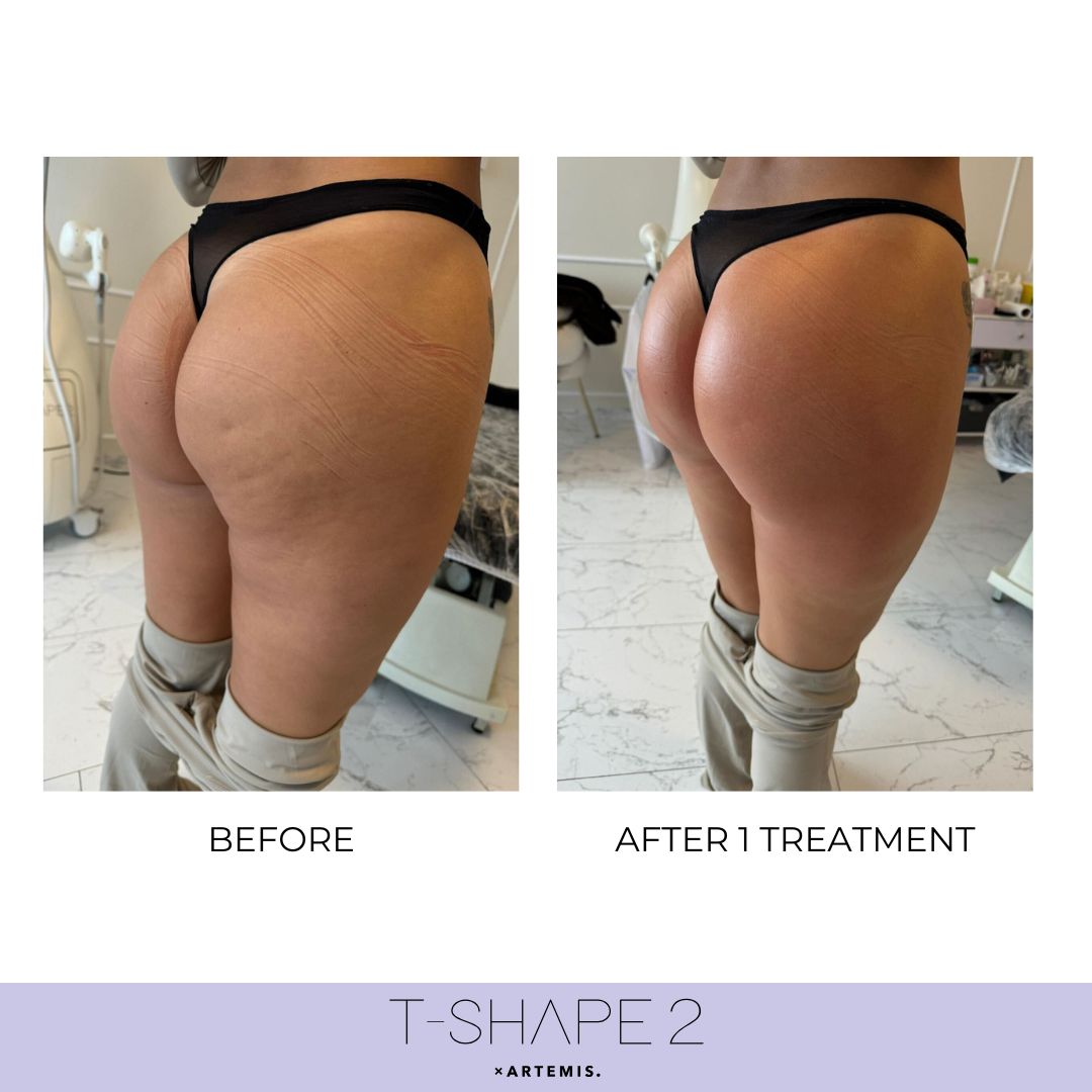 Body T-Shape 2 results — iCRYO Grosse Pointe