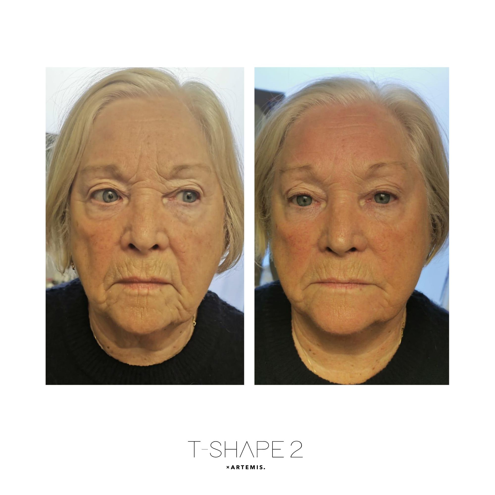Face T-Shape 2 results — iCRYO Grosse Pointe
