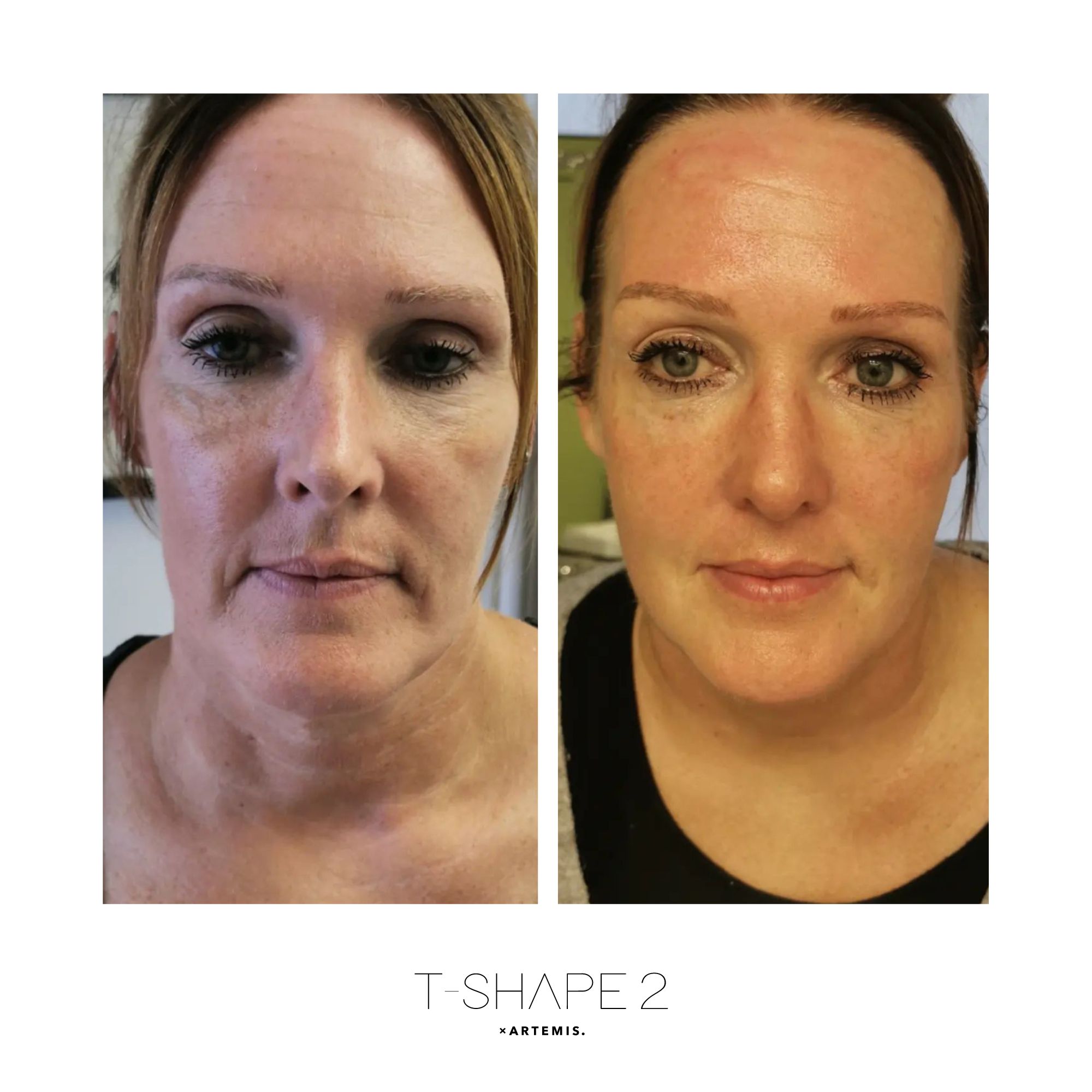 Face T-Shape 2 results — iCRYO Grosse Pointe