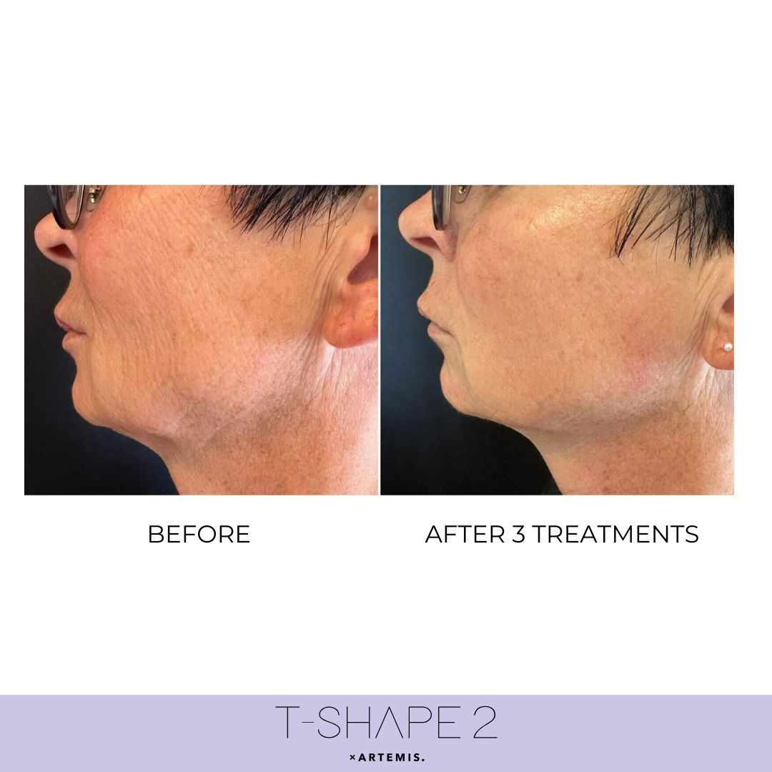 Neck T-Shape 2 results — iCRYO Grosse Pointe